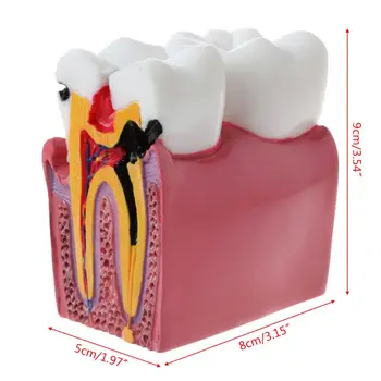 6 Ėduonies Comparation Anatomija Dantų Modelio Dantų Anatomija Lab Arbatos Dropship