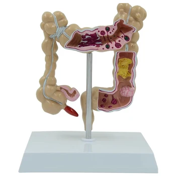 Storosios Žarnos Pažeidimas Anatomijos Modelis Žmogaus Gaubtinės Storosios Žarnos Patologijos Ligų Modelio Medicinos Organizatorius Įrangos Įrankis